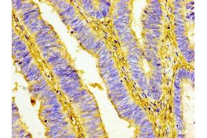 IHC image of ABIN7159833 diluted at 1:100 and staining in paraffin-embedded human colon cancer performed on a Leica BondTM system. (UCP1 antibody  (AA 2-307))