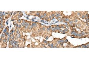 Immunohistochemistry of paraffin-embedded Human thyroid cancer tissue using BLNK Polyclonal Antibody at dilution of 1:40(x200) (B-Cell Linker antibody)
