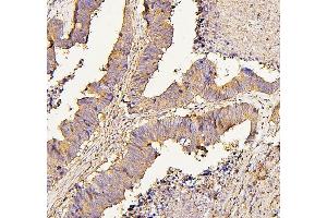 IHC analysis of NMI using anti-NMI antibody (ABIN6719489). (NMI antibody  (AA 2-307))