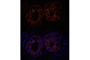 Immunofluorescence analysis of Human mammary cancer cells using TNF-α antibody (ABIN3020862, ABIN3020863, ABIN3020864, ABIN1513617 and ABIN6213762) at dilution of 1:100. (TNF alpha antibody  (AA 1-233))