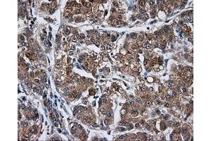 Immunohistochemical staining of paraffin-embedded Carcinoma of liver tissue using anti-KIAA1609 mouse monoclonal antibody. (KIAA1609 antibody)