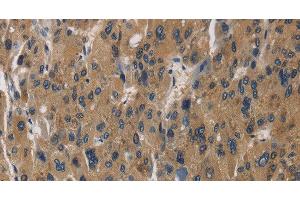 Immunohistochemistry of paraffin-embedded Human liver cancer using RAGE Polyclonal Antibody at dilution of 1:70 (RAGE antibody)