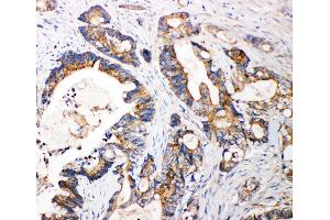 Anti-FGFR3 antibody, IHC(P) IHC(P): Human Intestinal Cancer Tissue