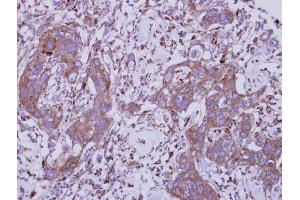 IHC-P Image Immunohistochemical analysis of paraffin-embedded human breast cancer, using TLR5, antibody at 1:250 dilution.