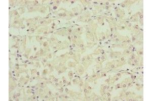 Immunohistochemistry of paraffin-embedded human gastric cancer using ABIN7160891 at dilution of 1:100 (NDUFA12 antibody  (AA 1-145))