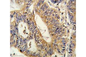 IHC analysis of FFPE human colon carcinoma stained with IL17RB antibody (IL17 Receptor B antibody  (AA 207-234))
