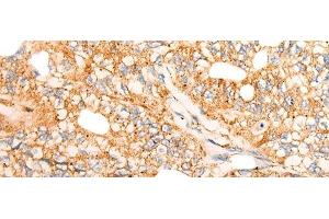 Immunohistochemistry of paraffin-embedded Human gastric cancer tissue using CHCHD3 Polyclonal Antibody at dilution of 1:45(x200) (CHCHD3 antibody)