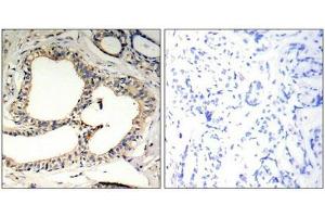 Immunohistochemical analysis of paraffin-embedded human breast carcinoma tissue using IkB-e(Phospho-Ser22) Antibody(left) or the same antibody preincubated with blocking peptide(right). (NFKBIE antibody  (pSer22))
