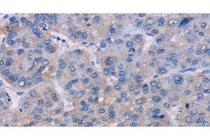 Immunohistochemistry of paraffin-embedded Human liver cancer tissue using NR1D1 Polyclonal Antibody at dilution 1:60