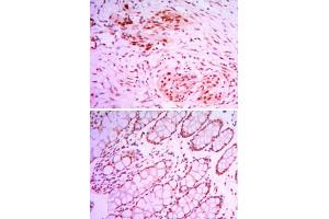 Immunohistochemical analysis of paraffin-embedded human colon cancer tissues (upper) and human larynx cancer tissues (bottom) using JMJD2A monoclonal antibody, clone 5H1  with DAB staining.