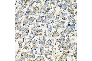 Immunohistochemistry of paraffin-embedded human lung cancer using ADSS antibody (ABIN6131467, ABIN6136604, ABIN6136606 and ABIN6216015) at dilution of 1:100 (40x lens). (ADSS antibody  (AA 1-280))