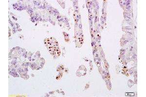 Formalin-fixed and paraffin embedded human breast carcinoma labeled with Anti-phospho-STAT3 (Tyr705) Polyclonal Antibody, Unconjugated (ABIN732638) at 1:200 followed by conjugation to the secondary antibody and DAB staining. (STAT3 antibody  (pTyr705))