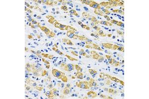 Immunohistochemistry of paraffin-embedded human liver cancer using SLC16A4 antibody. (SLC16A4 antibody)