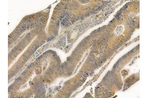 ABIN6261832 and ABIN6276853 at 1/100 staining human colon carcinoma by IHC-P. (Frataxin antibody  (Internal Region))