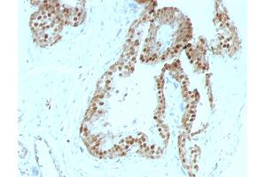 Formalin-fixed, paraffin-embedded human Prostate Carcinoma stained with p57 Mouse Monoclonal Antibody (KIP2/880).