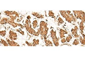 Immunohistochemistry of paraffin-embedded Human gastric cancer tissue using ZBTB43 Polyclonal Antibody at dilution of 1:40(x200) (ZBTB43 antibody)