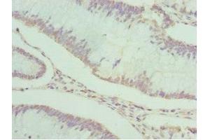 Immunohistochemistry of paraffin-embedded human colon cancer using ABIN7166867 at dilution of 1:100 (PDXK antibody  (AA 1-312))
