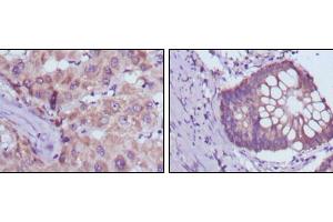 Immunohistochemical analysis of paraffin-embedded human liver cancer (left) and colorectal cancer tissues (right) using BDH1 mouse mAb with DAB staining. (BDH1 antibody)