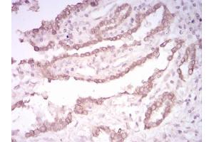 Immunohistochemical analysis of paraffin-embedded lung cancer tissues using CK5 mouse mAb with DAB staining. (Cytokeratin 5 antibody  (AA 258-357))