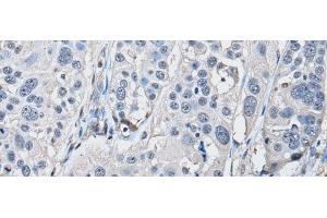 Immunohistochemistry of paraffin-embedded Human esophagus cancer tissue using PRKAR2A Polyclonal Antibody at dilution of 1:50(x200)
