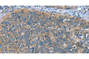 Immunohistochemistry of paraffin-embedded Human cervical cancer tissue using DTX1 Polyclonal Antibody at dilution 1:30 (Deltex Homolog 1 antibody)