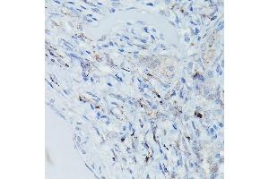 Immunohistochemistry of paraffin-embedded Human pulmonary tuberculosis using GSDME Rabbit pAb (ABIN6127757, ABIN6139554, ABIN6139555 and ABIN6223304) at dilution of 1:50 (40x lens). (Non-Syndromic Hearing Impairment Protein 5 (GSDME) (AA 1-260) antibody)