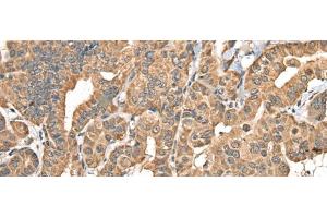 Immunohistochemistry of paraffin-embedded Human thyroid cancer tissue using NADK2 Polyclonal Antibody at dilution of 1:40(x200) (NADK2 antibody)