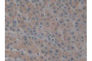 IHC-P analysis of Human Liver cancer Tissue, with DAB staining. (TAB1 antibody  (AA 189-439))