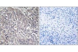 Immunohistochemistry analysis of paraffin-embedded human cervix carcinoma tissue, using InsP3R1 (Ab-1598/1588) Antibody. (ITPR1 antibody  (AA 1566-1615))