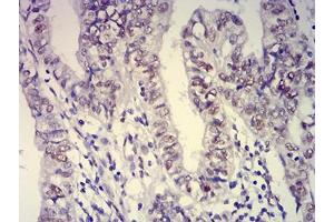 Immunohistochemical analysis of paraffin-embedded endometrial cancer tissues using ATXN1 mouse mAb with DAB staining. (Ataxin 1 antibody  (AA 645-815))