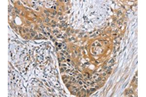 The image on the left is immunohistochemistry of paraffin-embedded Human esophagus cancer tissue using ABIN7192155(RBM38 Antibody) at dilution 1/35, on the right is treated with synthetic peptide. (RBM38 antibody)