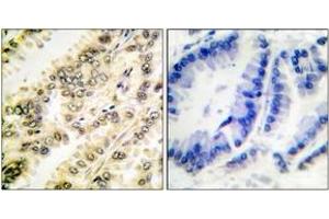 Immunohistochemistry analysis of paraffin-embedded human breast carcinoma, using SGK (Phospho-Ser422) Antibody. (SGK1 antibody  (pSer422))