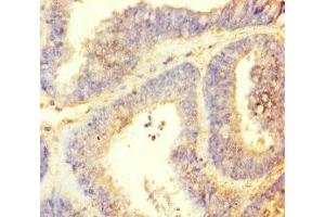 Immunohistochemistry of paraffin-embedded human endometrial cancer using ABIN7164621 at dilution of 1:100 (TTLL9 antibody  (AA 1-230))