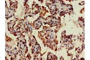 IHC image of ABIN7170794 diluted at 1:400 and staining in paraffin-embedded human lung cancer performed on a Leica BondTM system. (STING/TMEM173 antibody  (AA 207-379))