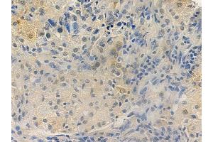ABIN6265916 and ABIN6277797 at 1/100 staining human lung squamous cell carcinoma by IHC-P. (USP22 antibody  (Internal Region))