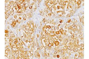 Formalin-fixed, paraffin-embedded human Melanoma stained with Melan-A Monoclonal Antibody (M2-9E3). (MLANA antibody)