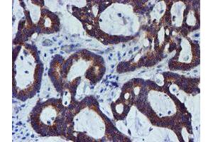 Immunohistochemical staining of paraffin-embedded Adenocarcinoma of Human colon tissue using anti-PDSS2 mouse monoclonal antibody. (PDSS2 antibody)