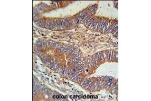 BIN2 Antibody (N-term) (ABIN651965 and ABIN2840476) immunohistochemistry analysis in formalin fixed and paraffin embedded human colon carcinoma followed by peroxidase conjugation of the secondary antibody and DAB staining.