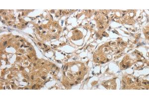 Immunohistochemistry of paraffin-embedded Human lung cancer using Amphiphysin I Polyclonal Antibody at dilution of 1:30 (Amphiphysin antibody)