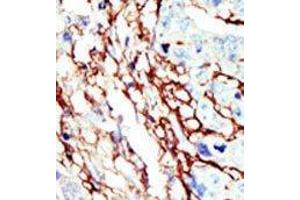 Formalin-fixed and paraffin-embedded human cancer tissue reacted with the primary antibody, which was peroxidase-conjugated to the secondary antibody, followed by AEC staining. (EPH Receptor A7 antibody  (C-Term))