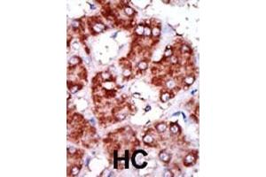 Formalin-fixed and paraffin-embedded human cancer tissue reacted with the primary antibody, which was peroxidase-conjugated to the secondary antibody, followed by DAB staining. (CPT1B antibody  (C-Term))