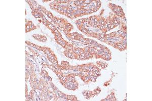 Immunohistochemistry of paraffin-embedded Human thyroid cancer using CDC20 antibody (ABIN7266246) at dilution of 1:100 (40x lens). (CDC20 antibody  (AA 1-270))
