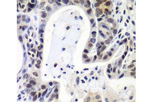 Immunohistochemistry of paraffin-embedded Human gastric cancer using LSM2 Polyclonal Antibody at dilution of 1:100 (40x lens). (LSM2 antibody)