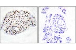 Immunohistochemistry analysis of paraffin-embedded human breast carcinoma tissue, using HDAC1 (Ab-421) Antibody. (HDAC1 antibody  (AA 387-436))