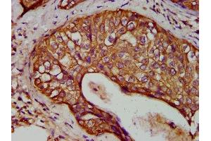 IHC image of ABIN7157412 diluted at 1:400 and staining in paraffin-embedded human cervical cancer performed on a Leica BondTM system. (Cytokeratin 1 antibody  (AA 267-438))