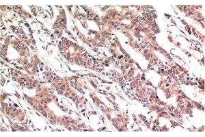 Immunohistochemistry of paraffin-embedded Human colon carcinoma tissue using Phospho-STAT3 (Tyr705) Monoclonal Antibody at dilution of 1:200. (STAT3 antibody  (pTyr705))