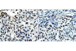 Immunohistochemistry of paraffin-embedded Human esophagus cancer tissue using DDX39A Polyclonal Antibody at dilution of 1:65(x200) (DDX39 antibody)