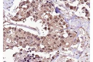 ABIN6267626 at 1/100 staining human colon carcinoma tissue sections by IHC-P. (FOXO1 antibody  (pSer256))
