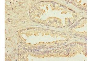 Immunohistochemistry of paraffin-embedded human prostate cancer using ABIN7157271 at dilution of 1:100 (KLHL13 antibody  (AA 1-260))
