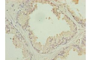 Immunohistochemistry of paraffin-embedded human prostate cancer using ABIN7175441 at dilution of 1:100 (PTPLB antibody  (AA 7-41))